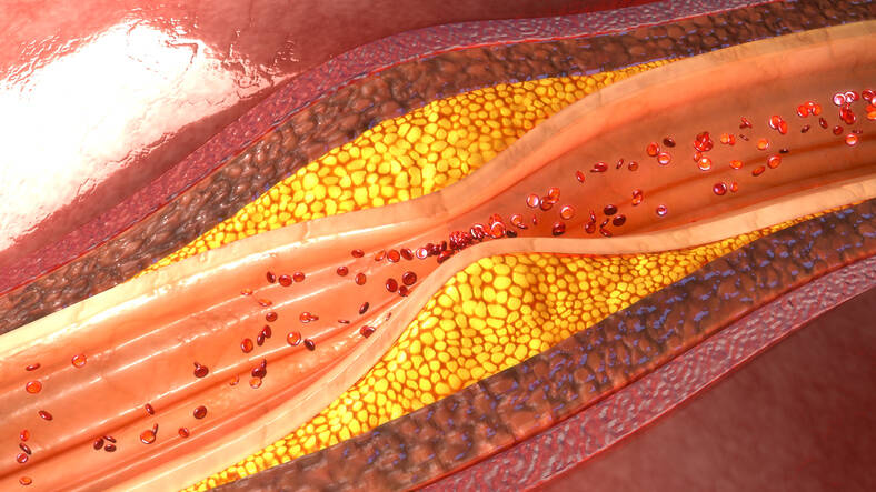 Atherosclerose: kent u de symptomen of oorzaken, risico's, preventie?