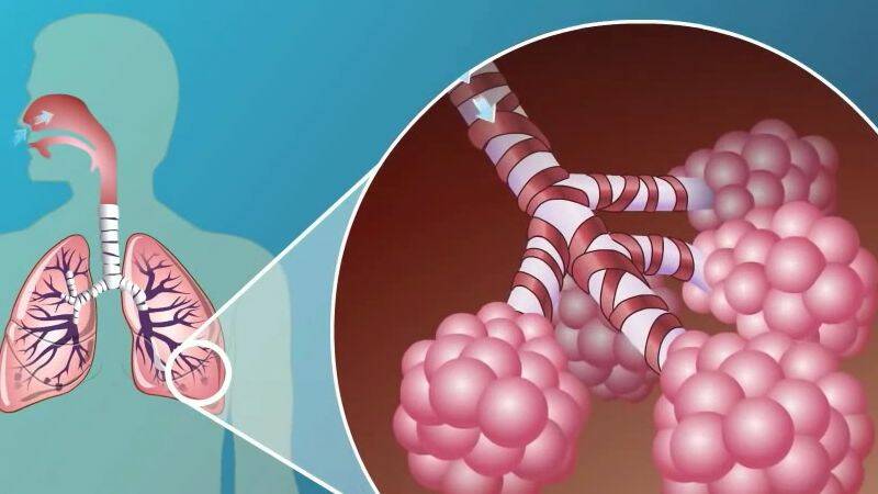 Chronische obstructieve longziekte: waarom komt het voor en wie loopt er risico?