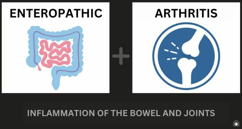 Enteropathische artritis en inflammatoire darmziekte: wat is hun verband + Symptomen