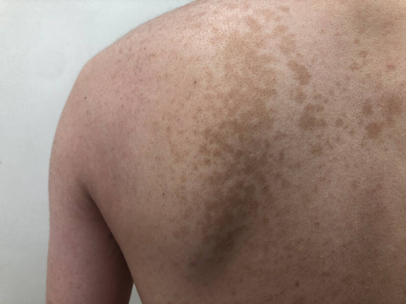 Pityriasis versicolor: wat is het en welke symptomen heeft het? Oorzaken en overdracht