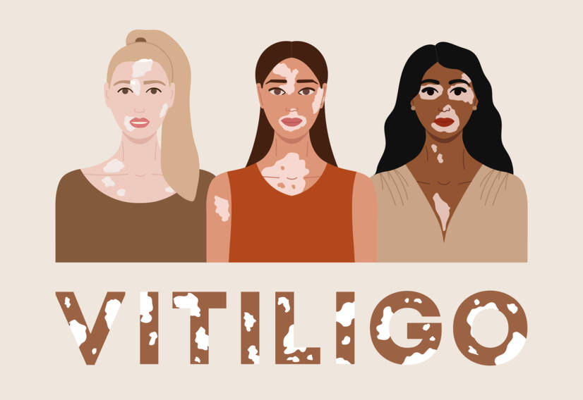 Vitiligo: Wat is vitiligo en wat zijn de oorzaken en symptomen? Wanneer begint het?