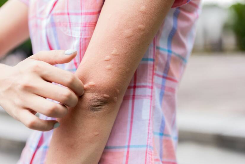 Urticaria: Urticaria niet alleen na een brandwond? Betekent het een ziekte?