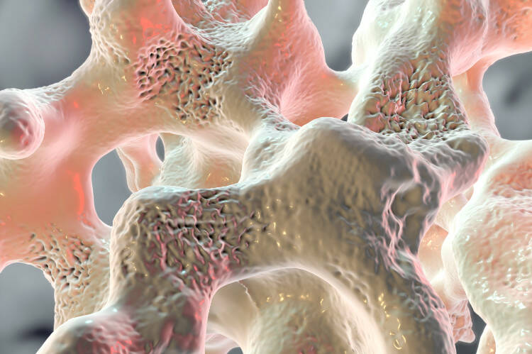 Osteoporose, osteogenese bij kinderen: waarom ontstaat het, hoe uit het zich, hoe wordt het behandeld?