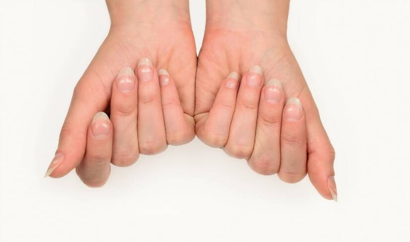 Witte vlekken op de nagels: wat betekenen ze en wat zijn de oorzaken?