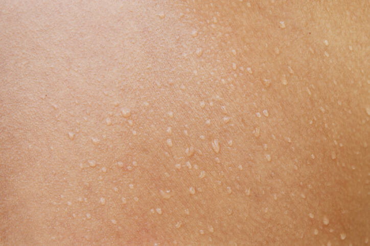 Natte huid door ontsteking, dermatitis of eczeem? Ken de oorzaken