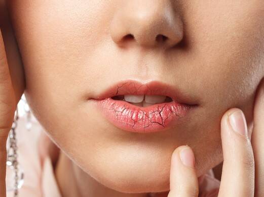 Gesprongen lippen: waarom zijn mijn lippen droog en gesprongen?