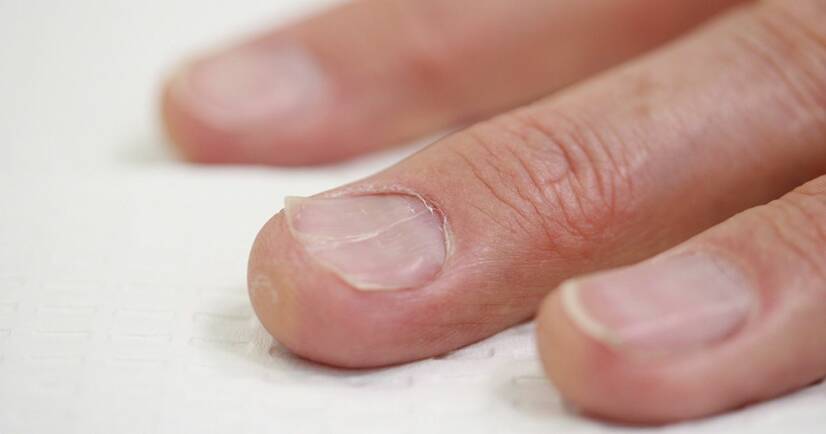 Ingegroeide nagels: waarom ontstaan ze? Diagnose en behandeling