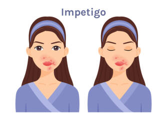 Wat is impetigo, welke symptomen heeft het? Besmettelijkheid en overdracht bij kinderen