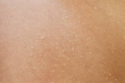 Natte huid door ontsteking, dermatitis of eczeem? Ken de oorzaken