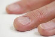 Ingegroeide nagels: waarom ontstaan ze? Diagnose en behandeling